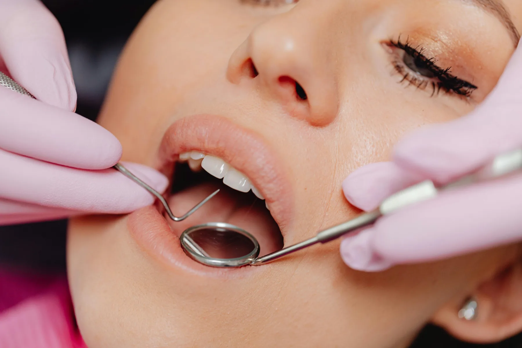Dental Abscess at Relax Dental & Facial Care