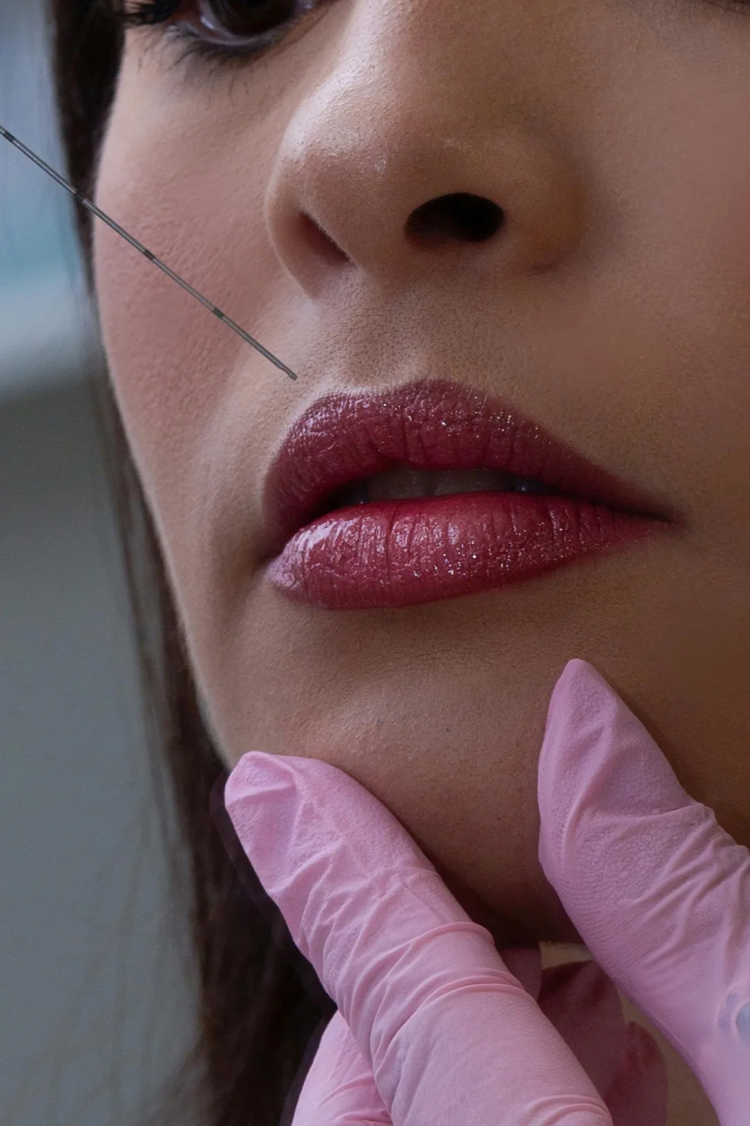 Facial aesthetic consultation for lip and facial contour concerns in Blackburn North