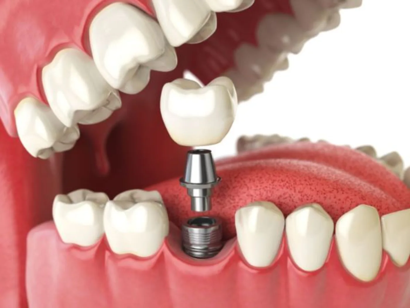 Dental implants consultation in Blackburn North
